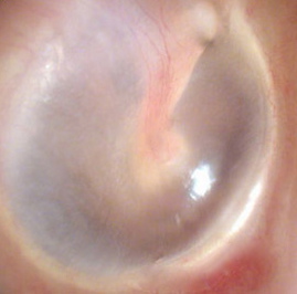 Fig 3-normal ear drum